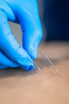 Dry needling treatment with fine needles